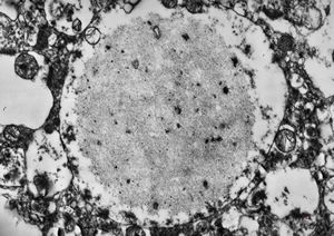M,71y. | Alzheimer diseaseaccompanied with CADASIL - amyloid body M,71y. | Alzheimer diseaseaccompanied with CADASIL - amyloid body